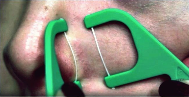 Trucos de belleza ingeniosos para eliminar puntos negros y blancos