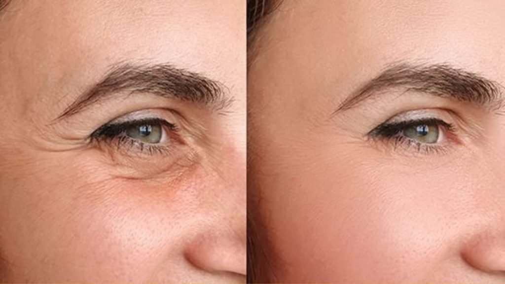 Esta crema natural elimina las patas de gallo de tu rostro en solo una semana