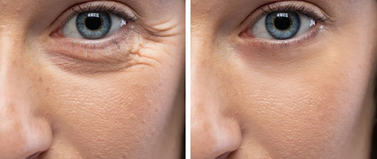 Un truco de clara de huevo para levantar los párpados caídos