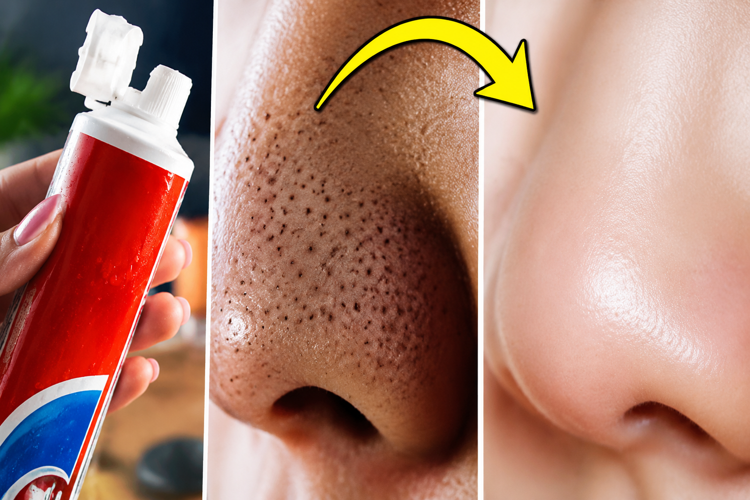 Descubre cómo eliminar los puntos negros con un truco casero y efectivo usando pasta dental