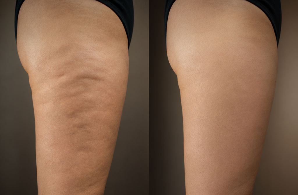 Esta crema casera ayuda a reducir la celulitis en solo 7 días